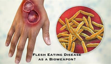 Buruli ulcer